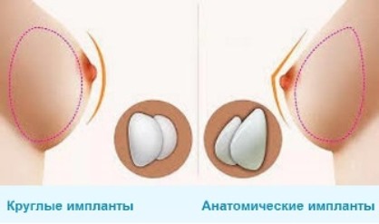 фото круглых и анатомических имплантов